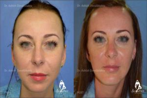 Frequently Asked Questions about Facelift Surgery India
