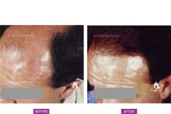 Why Pune is the best destination for Hair Transplant?