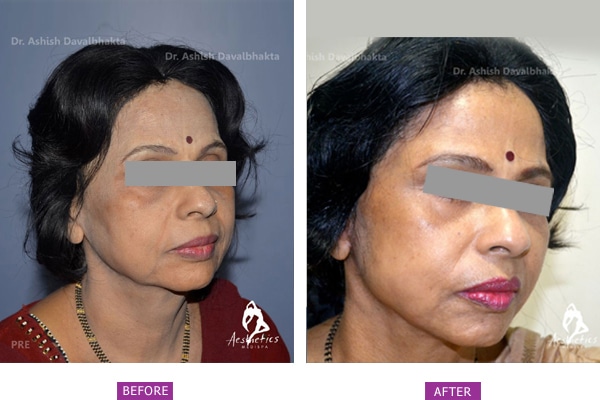 Rhinoplasty before after image