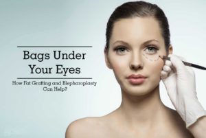 Read more about the article Bags Under Your Eyes – How Fat Grafting and Blepharoplasty Can Help?