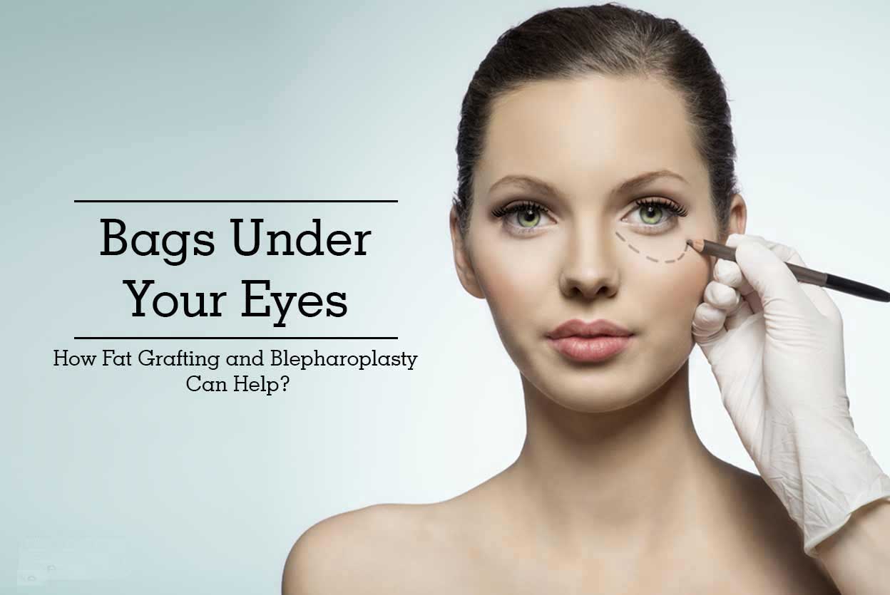 Bags Under Your Eyes – How Fat Grafting and Blepharoplasty Can Help?