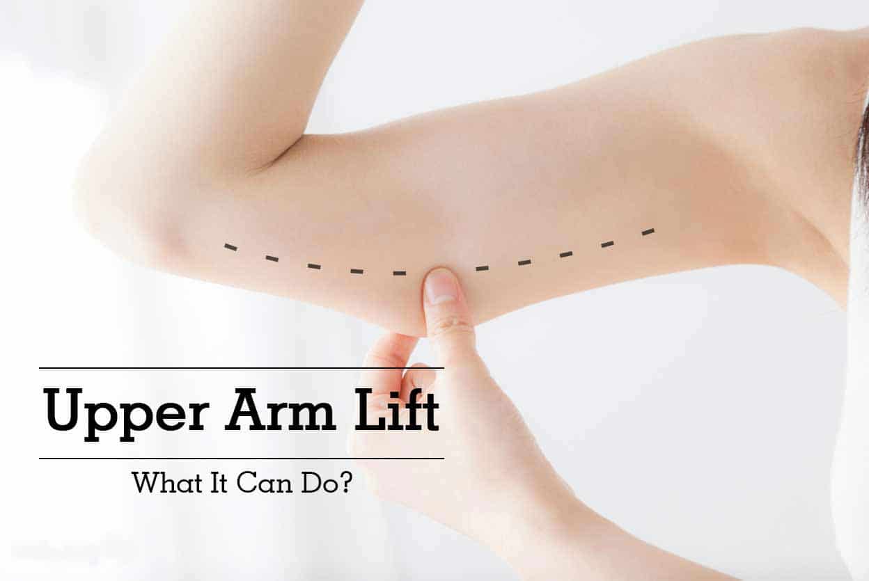 Upper Arm Lift – What It Can Do?