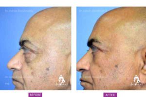 Case 2: Upper and Lower Blepharoplasty Side View