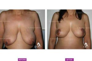 Breast Lift Case 1: Breast Sagging Following Massive Weight Loss