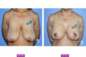 Breast Lift Case 2: Post Bariatric Breast Sagging