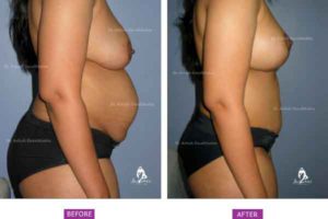 Breast Lift Case 3: Tummy Tuck With Breast Lift (Side View)
