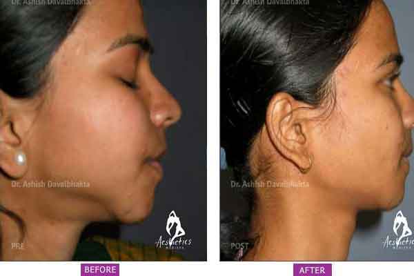 Case 3: Chin Augmentation Side View