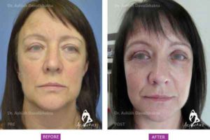 Case 1: Upper and Lower Blepharoplasty, Fat Grafting