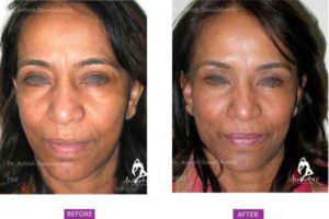 Case 5: Upper and Lower Eyelid Blepharoplasty