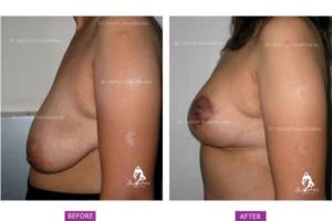 Breast Lift (Mastopexy) Case 1: Side View