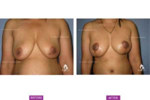 Breast Lift Case 3: Post Pregnancy Sagging/ Deflation