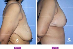 Breast Lift Case 2: Side View