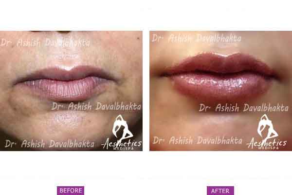 Case 1: Lip Augmentation and Fillers