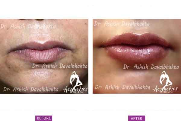 Lip Augmentation (Shaping) using Fillers at aesthetic medispa in pune by Dr. Ashish Davalbhakta