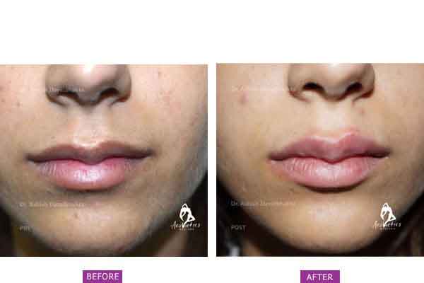 Lip Shaping using Fillers at aesthetic medispa in pune by Dr. Ashish Davalbhakta