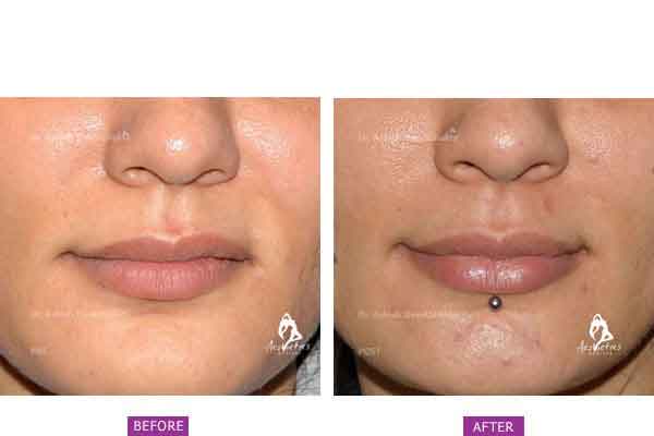 Lip Shaping using Fillers at aesthetic medispa in pune by Dr. Ashish Davalbhakta