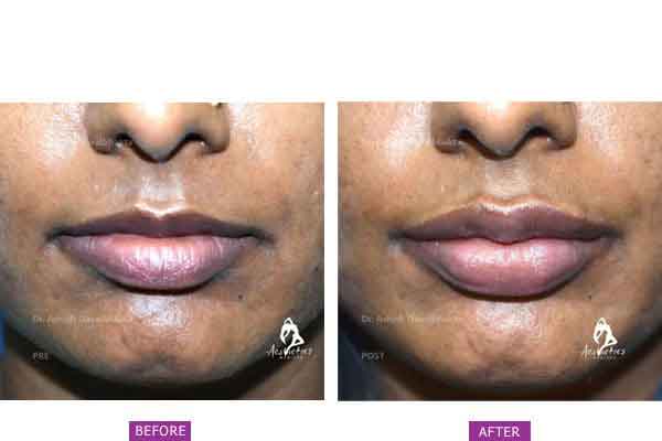 Case 3: Lip Augmentation and Fillers