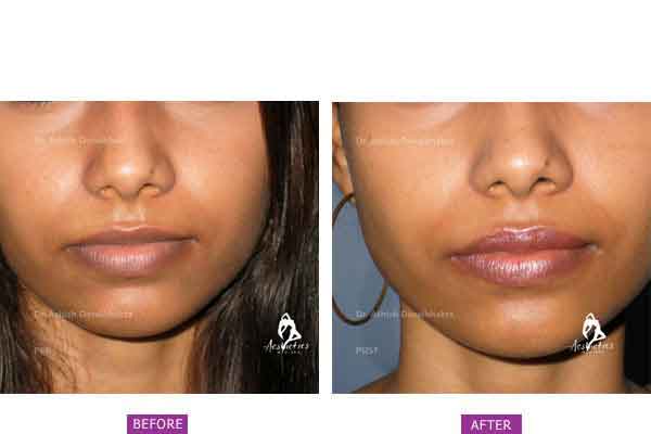 Lip Shaping using Fillers at aesthetic medispa in pune by Dr. Ashish Davalbhakta