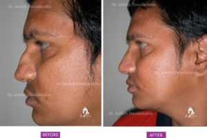 Nose Surgery Case 1: Correction of Deviation and Hump : Side View