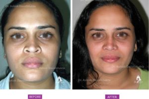 Rhinoplasty Case 5: Augmentation with Alar Flare Correction: Front View