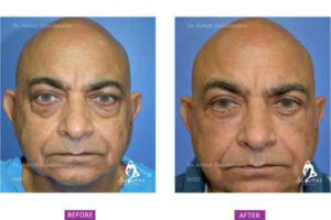 Case 2: Upper and Lower Blepharoplasty, Fat Grafting