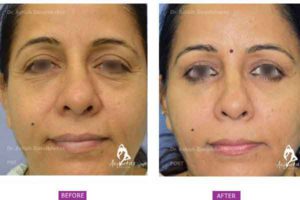 Case 3: Upper and Lower Blepharoplasty