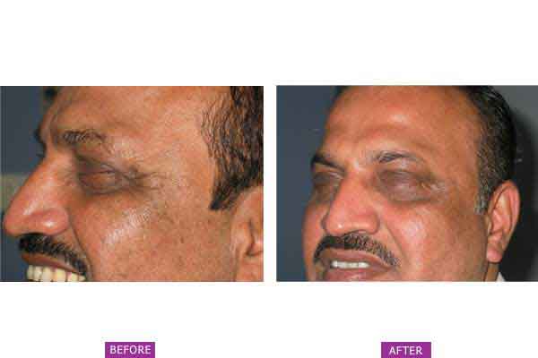 Case 1: Botox Treatment Side View (b)