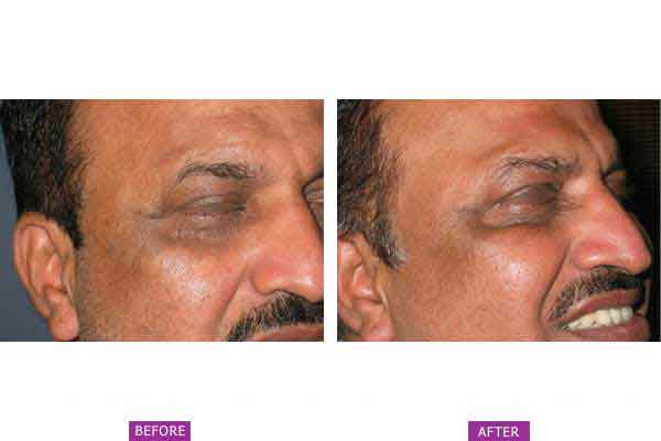 Case 1: Botox Treatment Side View (a)