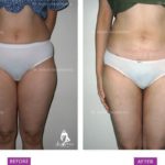 Case 1: Standard Liposuction of Abdomen, Flanks, Lower Back and Inner Thighs