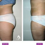 Case 1: Standard Liposuction : Side View