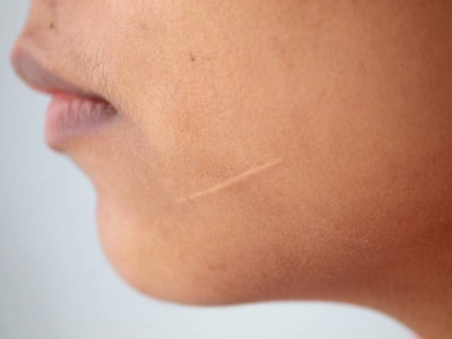 Read more about the article Scar Removal/Improvement