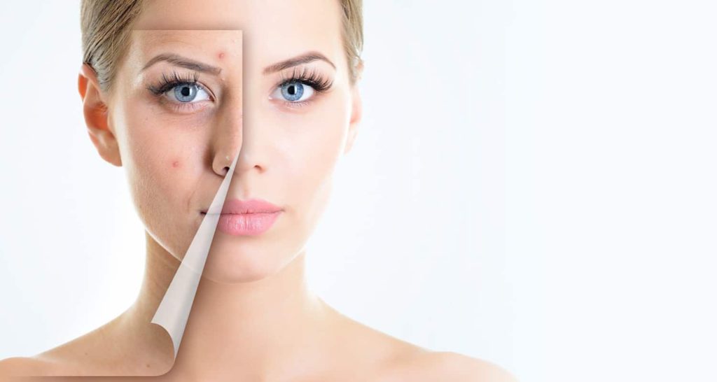 acne and acne scar