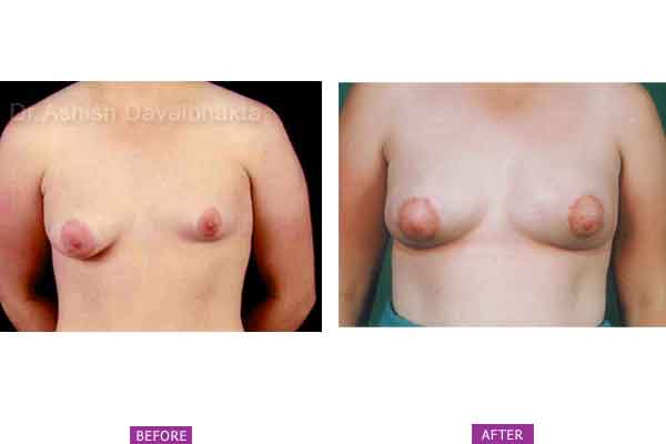 Asymmetrical Breasts Surgery Case 3: Bilateral Operated Tuberous Breast
