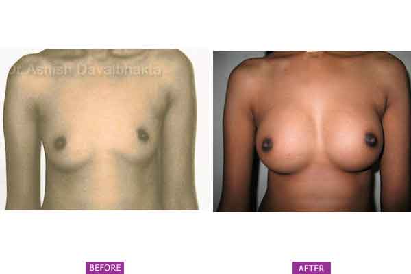 Asymmetrical breasts surgery Case 4: Bilateral Hypoplasia with Nipple Asymmetry