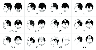 Male Pattern Baldness