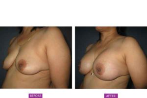 Breast Augmentation Surgery Case 6: 300 cc Subfascial Augmentation
