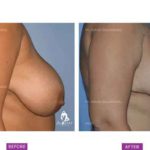 Case 4: Breast Reduction Surgery (Side View)