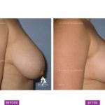 Case 1: Breast Reduction Side View