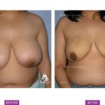 Case 3: Breast Reduction by Liposuction