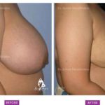 Case 3: Breast Reduction Surgery (Side View)