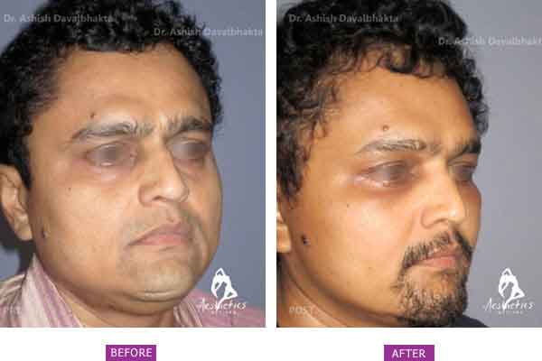 Facelift Surgery Case 2: Oblique View
