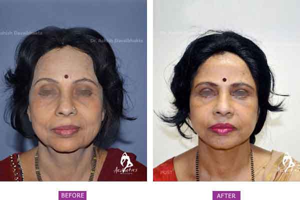 Case 3: (Post Bariatric Ageing) Upper Lower Eyelid Blepharoplasty, Neck lift, Facelift