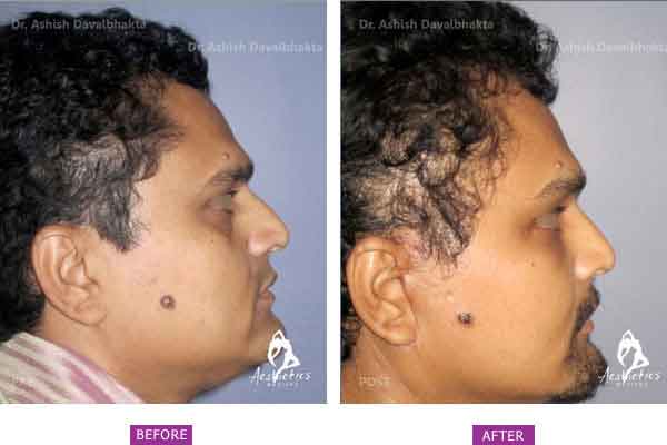Facelift Surgery Case 2: Side View