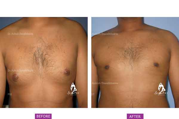 Case 1: Grade 1 Gynaecomastia Treated by Liposuction Only