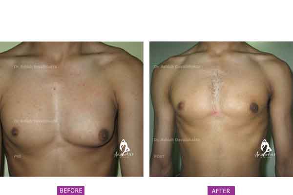 Case 3: Unilateral Left Gynaecomastia Treated by Gland Excision