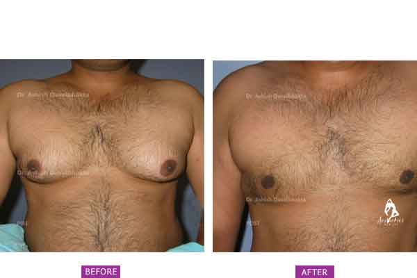 Case 9: Grade 2 Gynaecomastia Treated by Liposuction and Gland Excision
