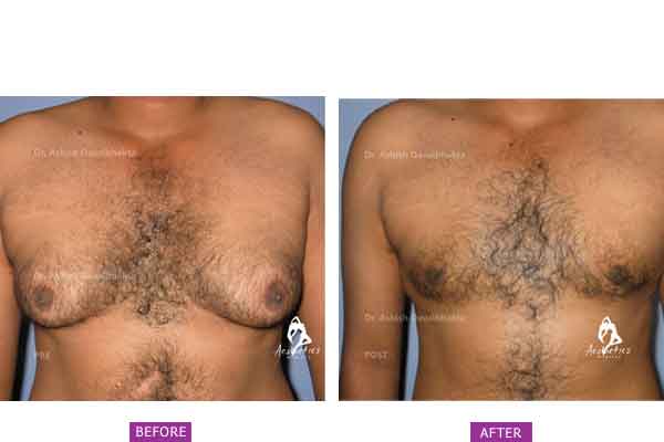Case 2: Grade 2 Gynaecomastia Treated by Liposuction and Gland Excision