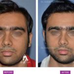 Hair Transplant Case 1 : Medical Hair Transplant : Front View