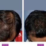 Case 1 : Medical Hair Transplant : Top View