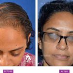 Case 2 : Medical Hair Transplant : Front View